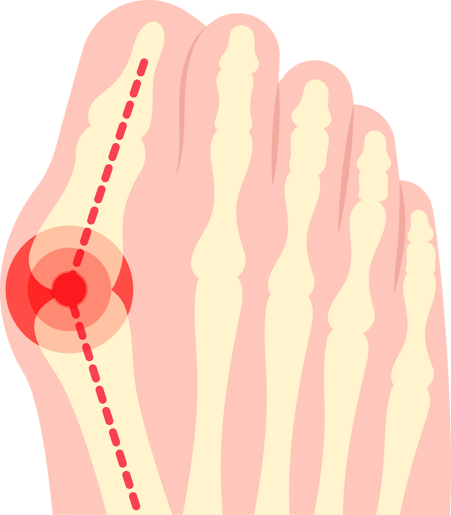 bunion hallux valgus toe pain injury bone big deformity arthritis bunionettes soreness Corns calluses ganglion rigidus foot Rheumatoid cyst Bursitis swollen Hammertoe turf Metatarsalgia tailor hammer gout fracture